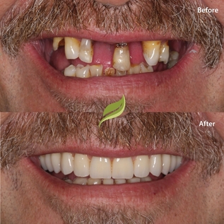 Before and after dental treatment 1