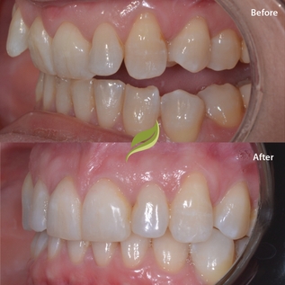 Before and after dental treatment 2